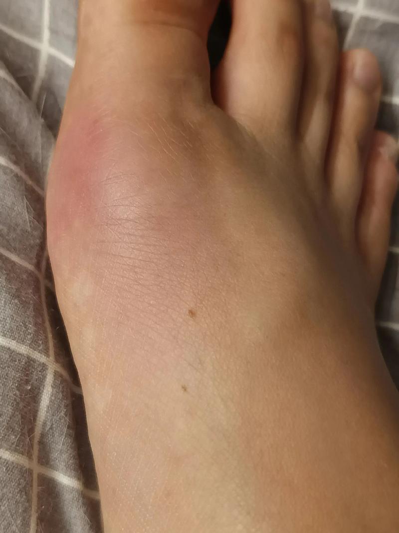 痛风十天没消肿怎么办