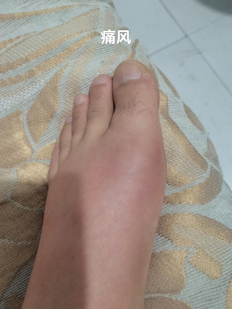 痛风一个多月了还没好