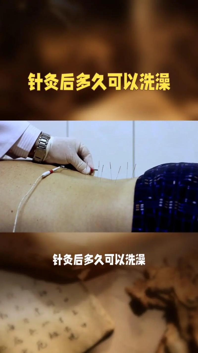 针灸过后多久可以洗澡