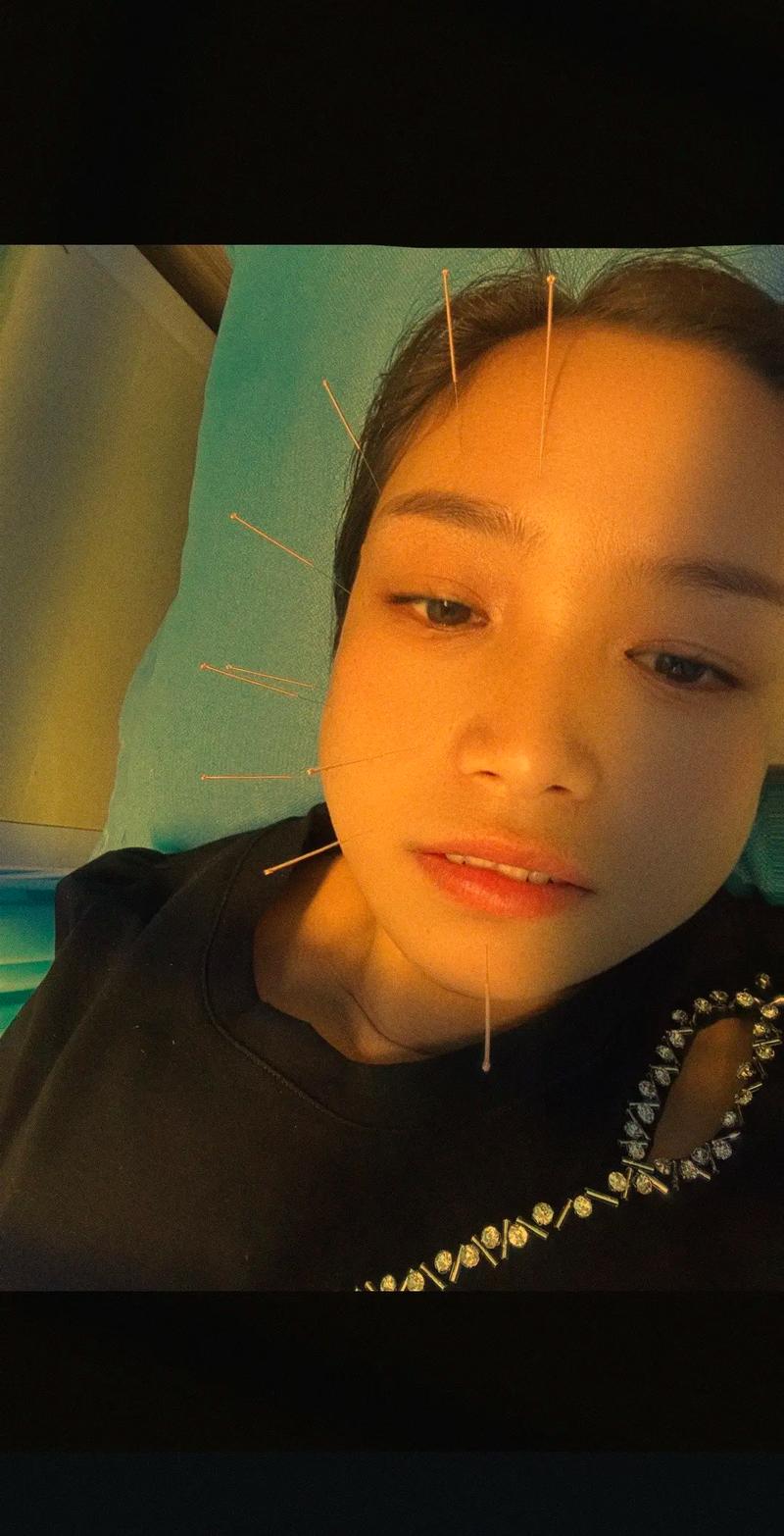 面瘫做针灸要针灸几天