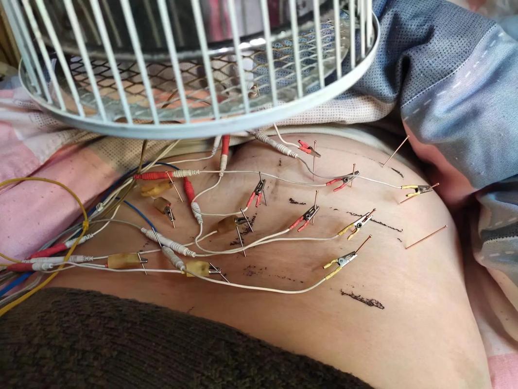 腰间盘突出针灸后更痛