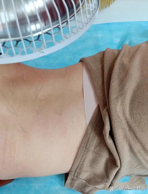 腰间盘突出针灸后更痛