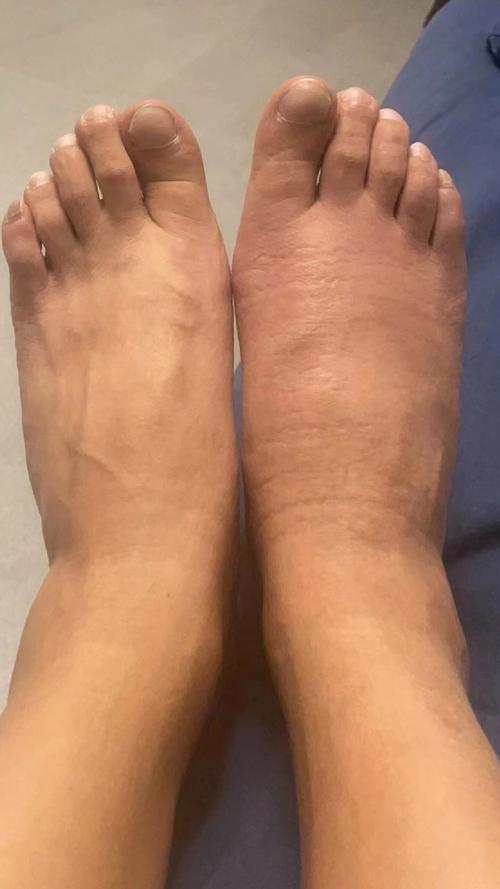 男朋友痛风还能一起吗