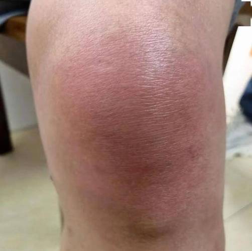 膝关节痛风是什么症状