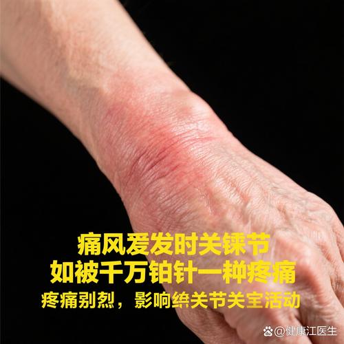 痛风秋水仙碱越吃越痛