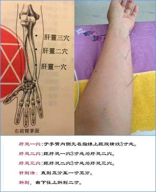 针灸治抑郁症效果如何