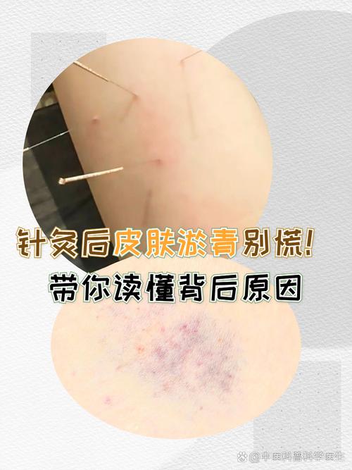 针灸后屁多是什么原因