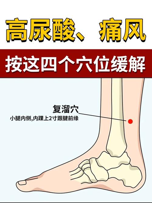 痛风性关节炎怎么艾灸