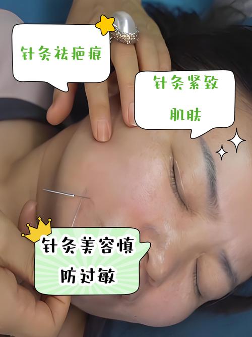 美容院针灸减肥靠谱吗