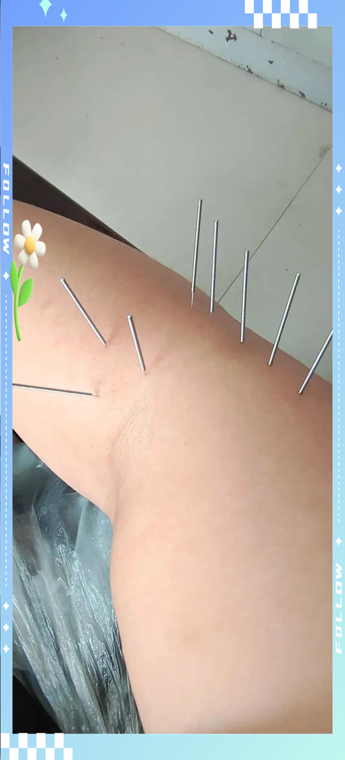 扎完针灸后为什么更疼