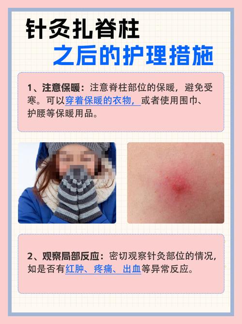 针灸和微针针刺的区别