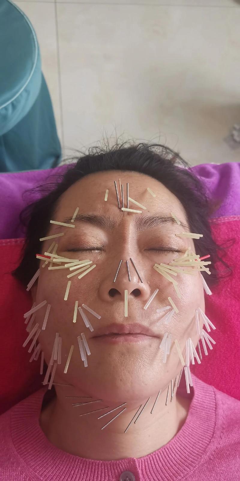 针灸美雕的好处与坏处