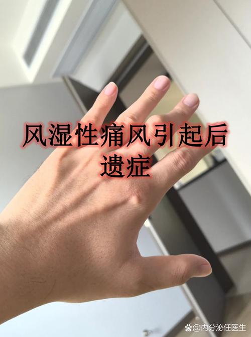 上夜班对痛风有影响吗