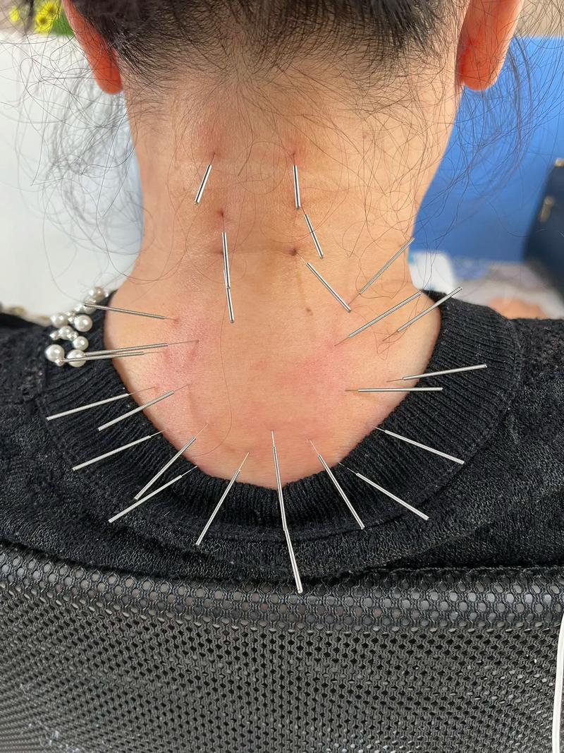 针灸后起包是怎么回事