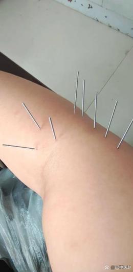 针灸后起包是怎么回事