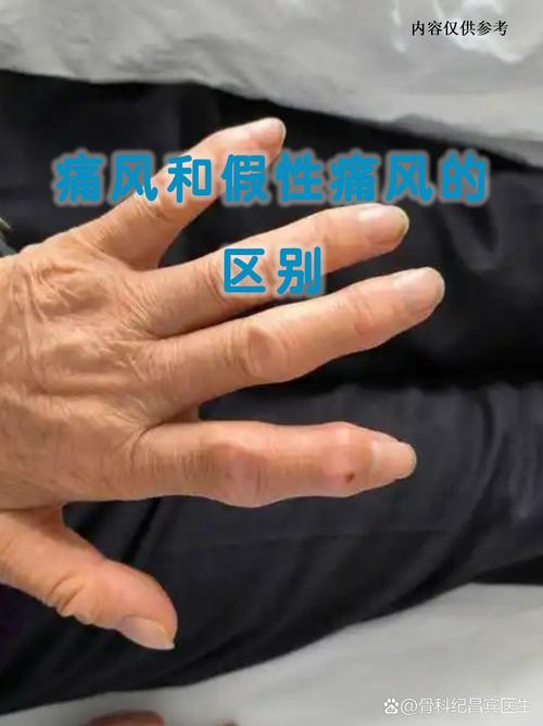 为什么日本人不得痛风