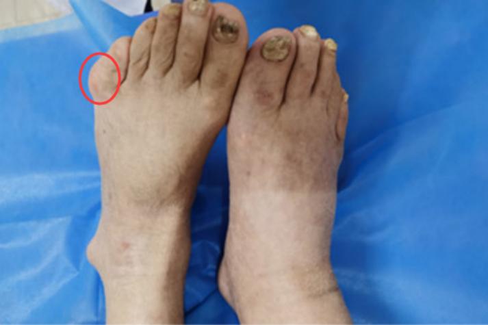 小脚指外侧痛是痛风吗