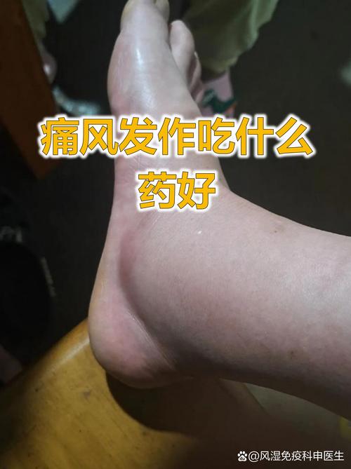 痛风发作能吃止疼药吗