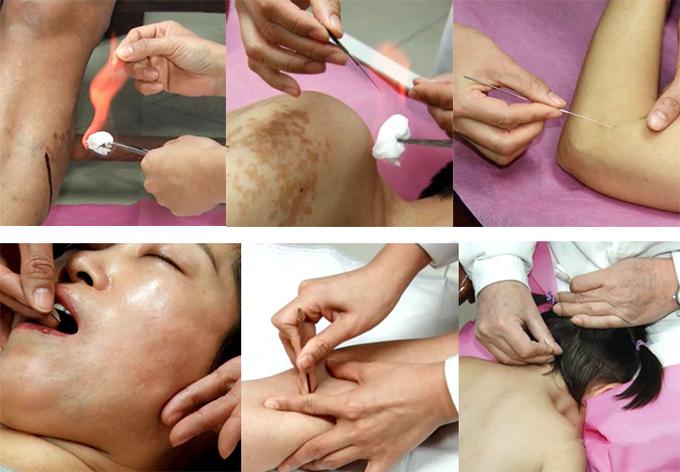 针灸贺喜和贺林哪个好