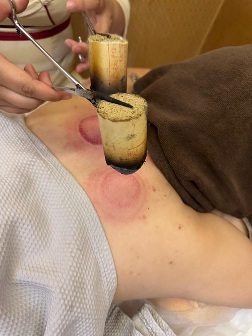 贴针灸加强版丰胸效果