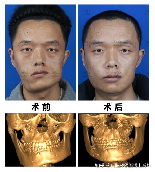 现在的削骨手术安全吗