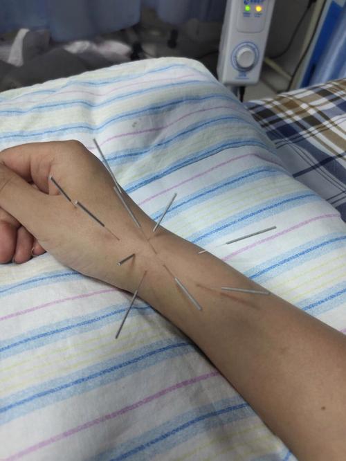 腕关节腱鞘炎怎么针灸