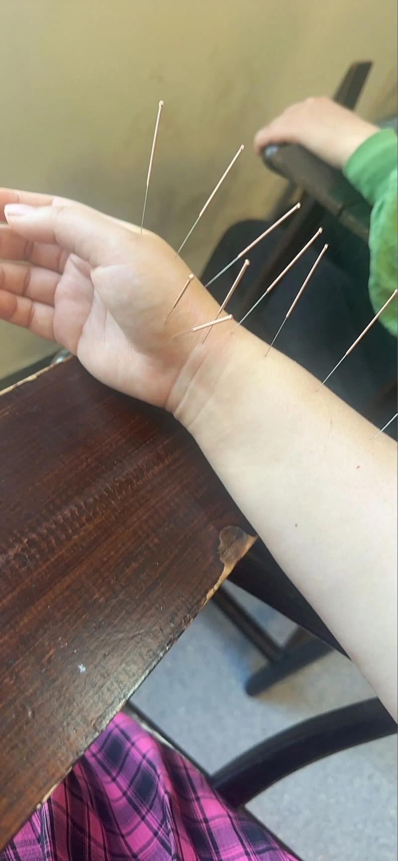 腕关节腱鞘炎怎么针灸