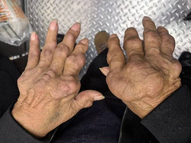 痛风看骨科还是内分泌