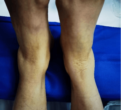 痛风看骨科还是内分泌