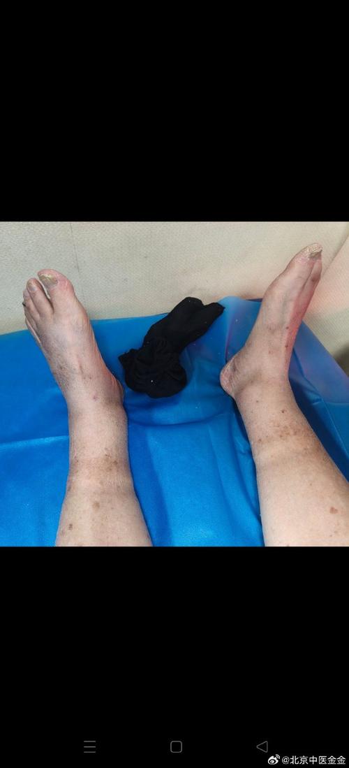 针灸治疗脑血栓后遗症