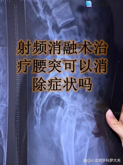 腰椎盘突出手术安全吗