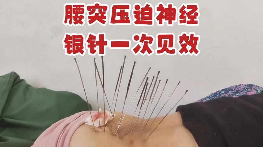 火针针灸坐骨神经视频