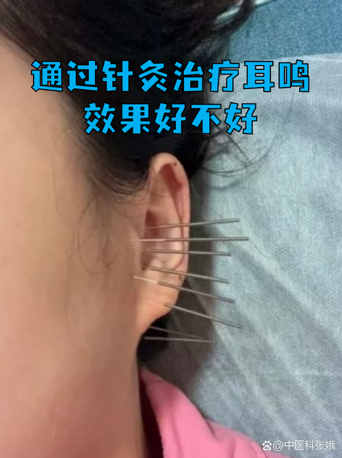 耳鸣针灸后严重怎么办