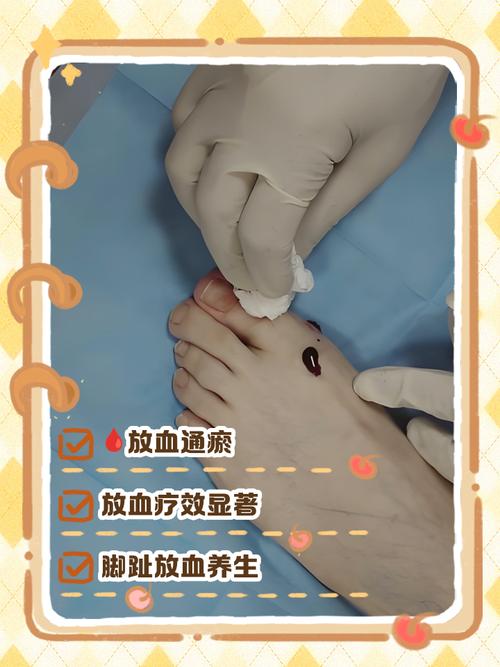 脚底针灸能治高血压吗