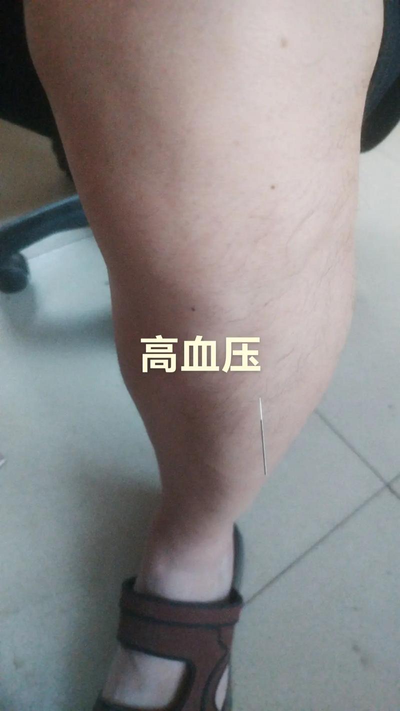 脚底针灸能治高血压吗