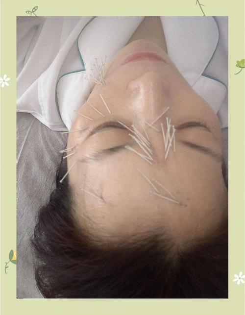 面部美容针灸扎的图片