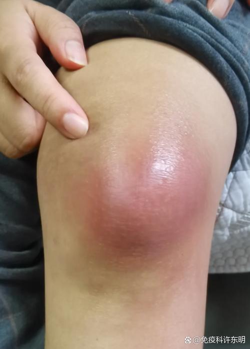 痛风的症状表现是什么