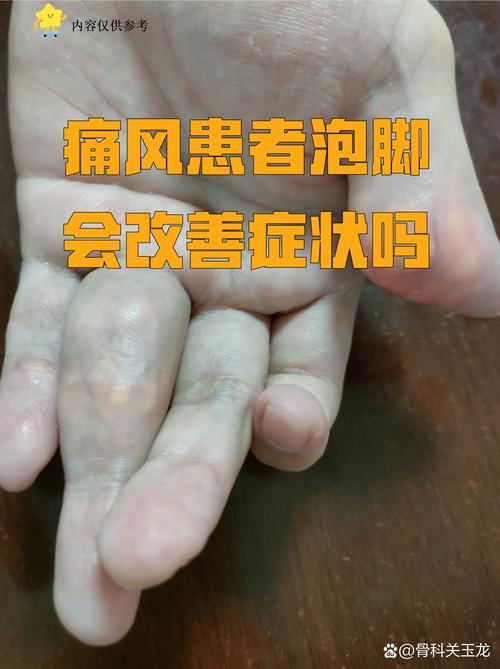 急性痛风期间能洗澡吗