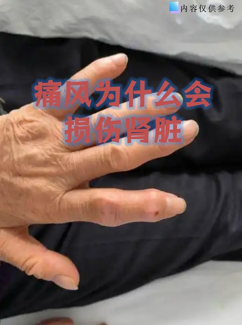 痛风肾症状的早期表现