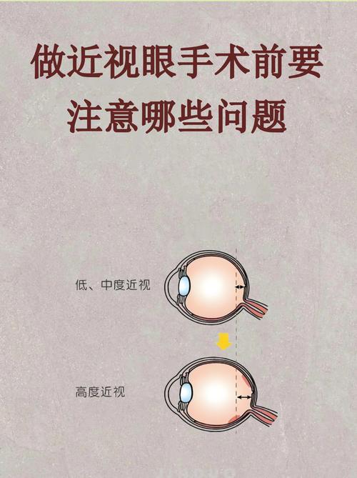 近视眼手术现在安全吗