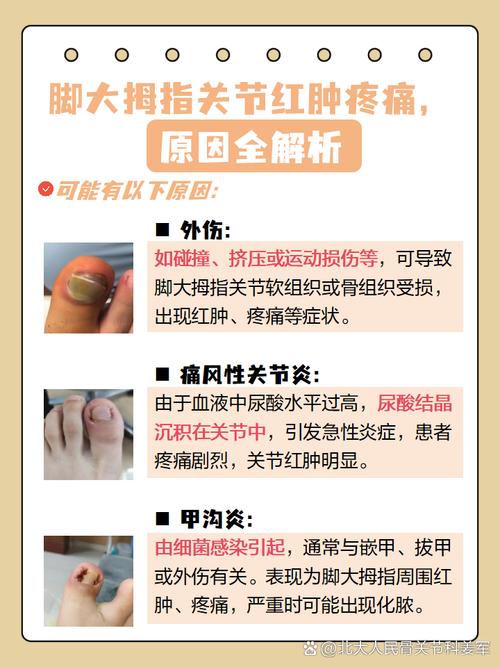 痛风引起脚痛怎么止痛