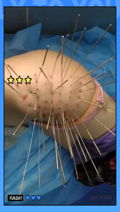 银针针灸可以治什么病