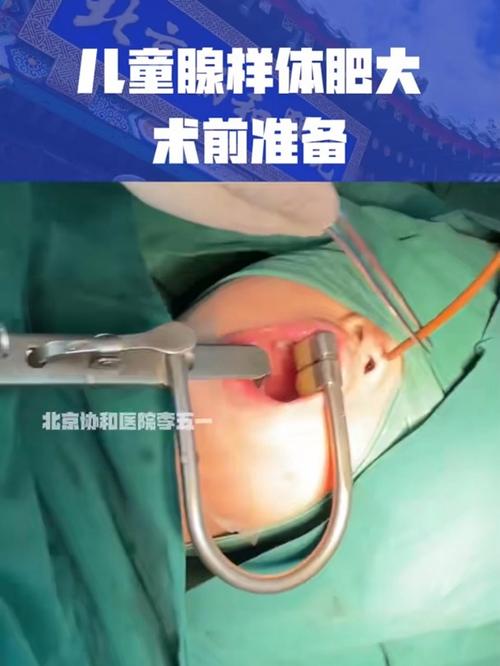 腺样体切除手术安全吗