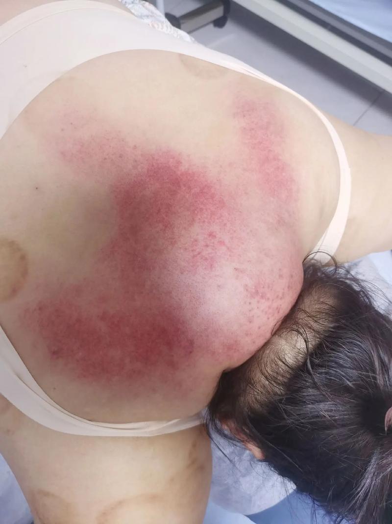 针灸出现疙瘩怎么处理