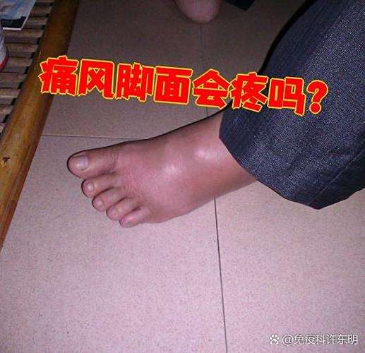 脚背疼不红肿是痛风吗