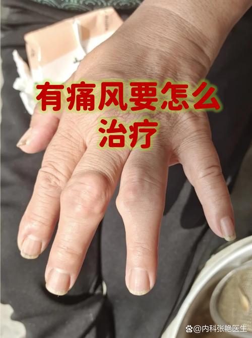 目前世界治疗痛风进展