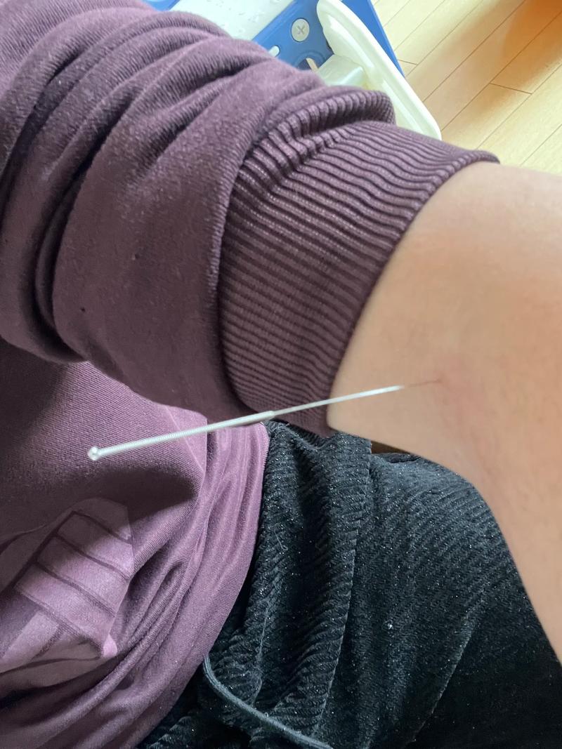 针灸甲状腺结节没有了