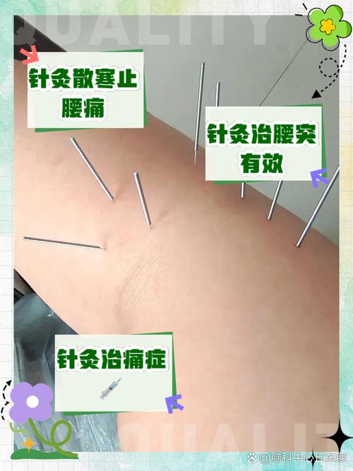 针灸治疗腰疼效果好吗