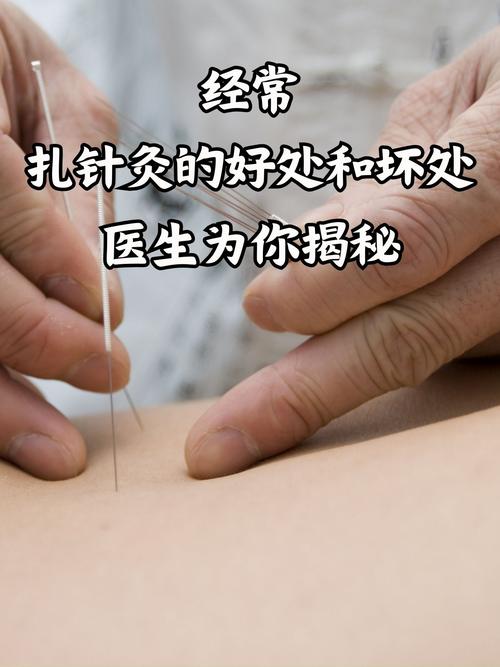 针灸可以连续扎一年吗