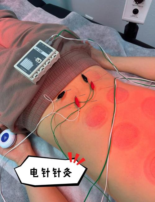 腰间盘突出做针灸好吗